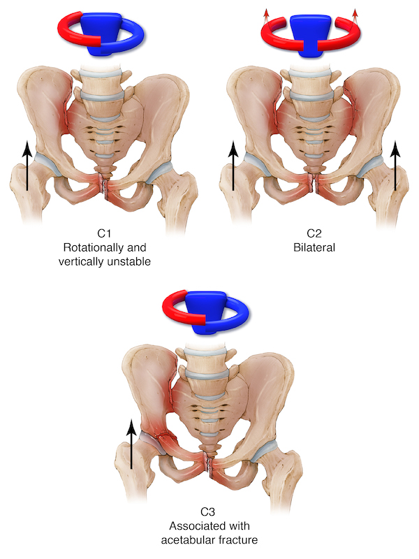 Pelvic fractures